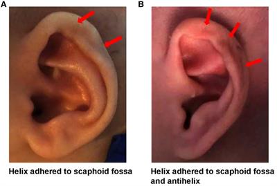 Using ear molding to correct auricular helix adhesion deformity